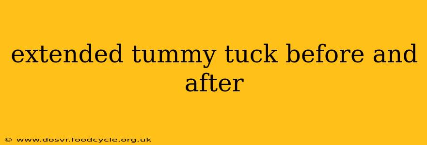 extended tummy tuck before and after