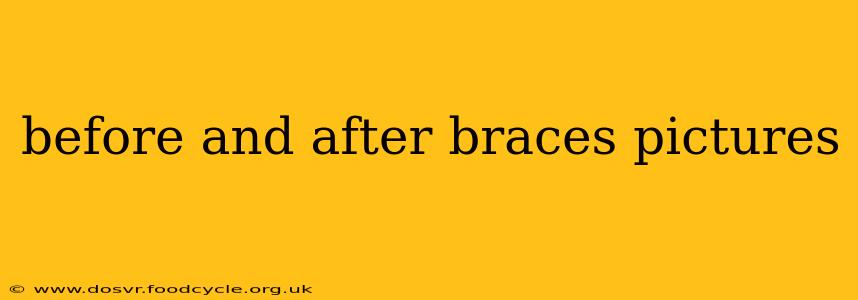 before and after braces pictures