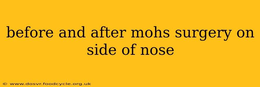 before and after mohs surgery on side of nose