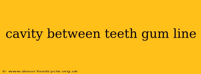 cavity between teeth gum line