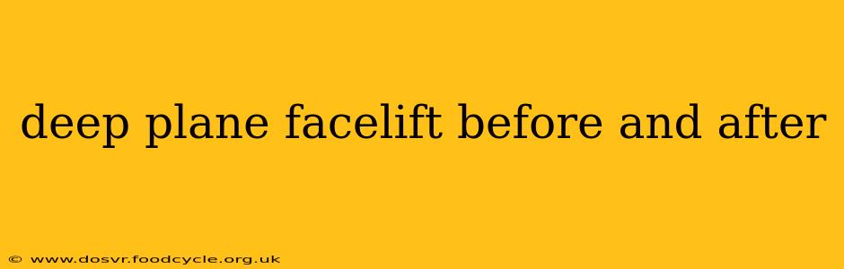 deep plane facelift before and after