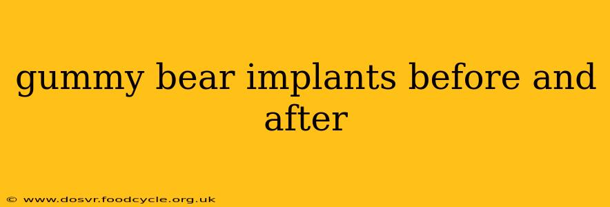 gummy bear implants before and after