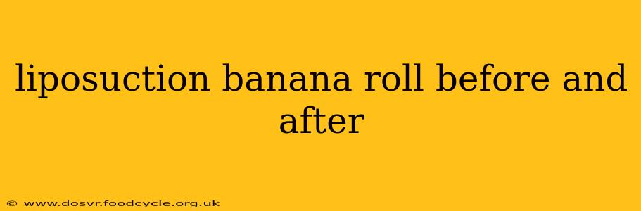 liposuction banana roll before and after